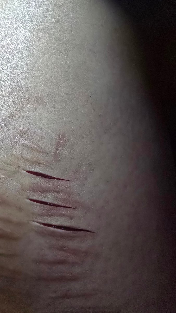 fionas_diary's tweet photo. Im so pissed. I relapsed and cut myself, got in touch my with ex who loved when i cut https://t.co/61p4qiR4ZQ