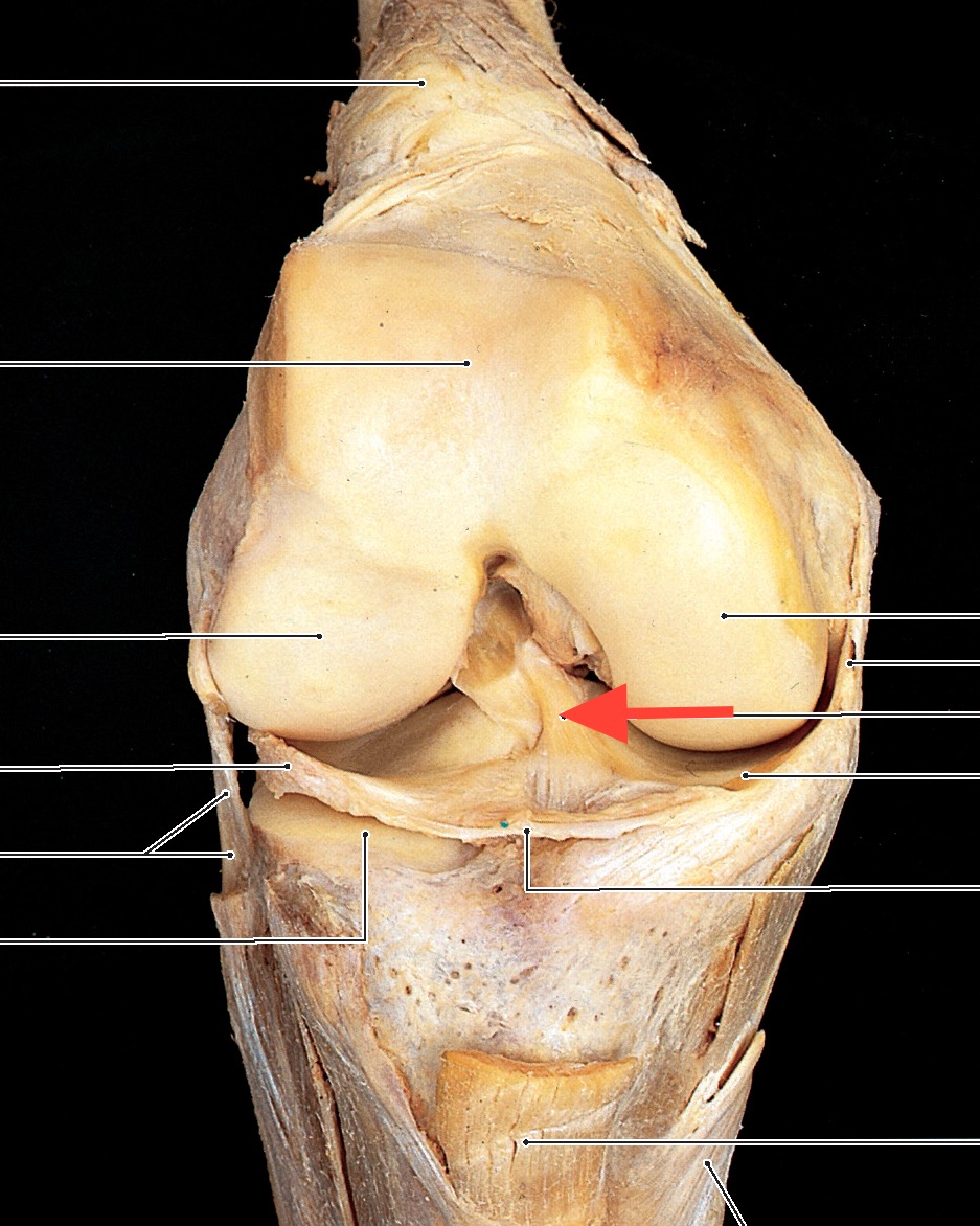 PasionAnatomia's tweet image. ¿Por qué el #LigamentoCruzadoAnterior (#LCA 🔴) se lesiona con más frecuencia que el posterior?
El #LigamentoCruzadoPosterior (🔵) es más corto y más potente que el LCA, por lo que se lesiona hasta 10 veces menos.
📚Atlas de anatomía humana. Rohen © 2021