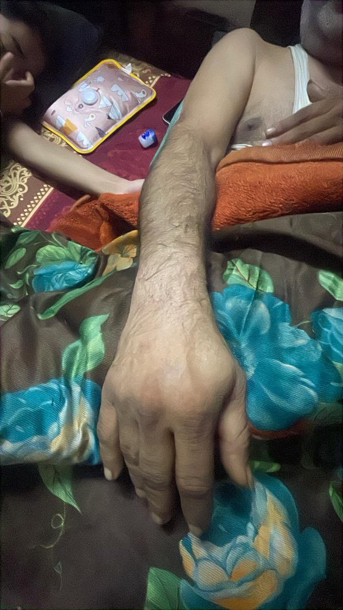 GBNVikasSamiti's tweet photo. @dmgbnagar Urgent action needed- 
@lalpathlabs Despite multiple complaints, Varun Bhatija’s hand swelling and restricted movement after blood test (Lab No. 496548529, 31-12-25) remains unresolved for 12+ days. @myogiadityanath @cmogbnr @UP_Swasth @brajeshpathakup @dr_maheshsharma https://t.co/6iYRCbEqlG