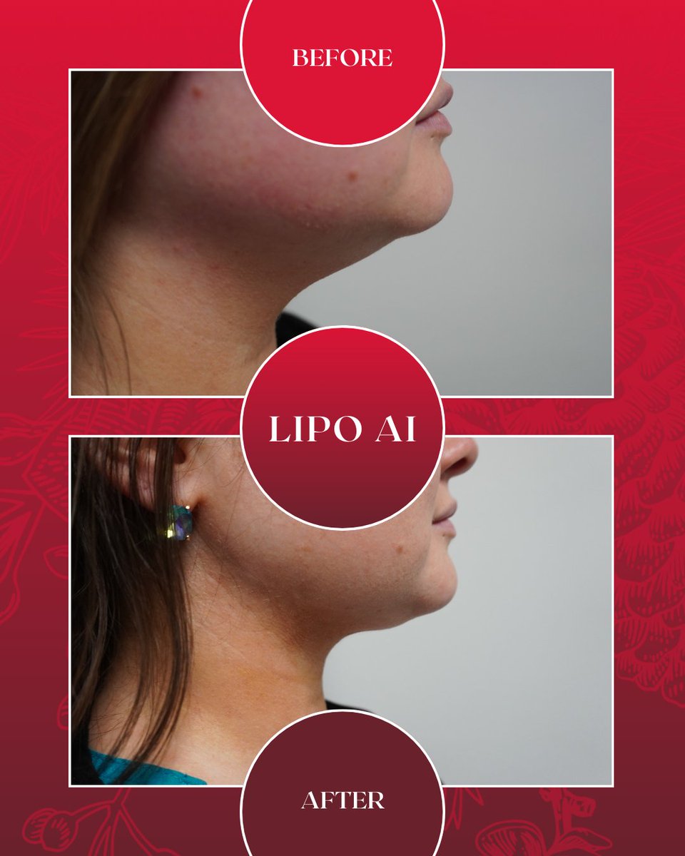 bellissimops's tweet photo. By targeting excess volume under the chin and along the jawline, we refine the lower face for a more contoured silhouette with less downtime than traditional methods. https://t.co/Lr5l8YP1TK