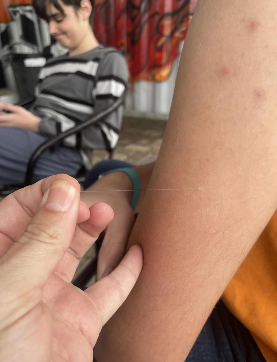 Some people randomly grow abnormally long hairs because a single hair follicle stays in its growth phase longer than the rest