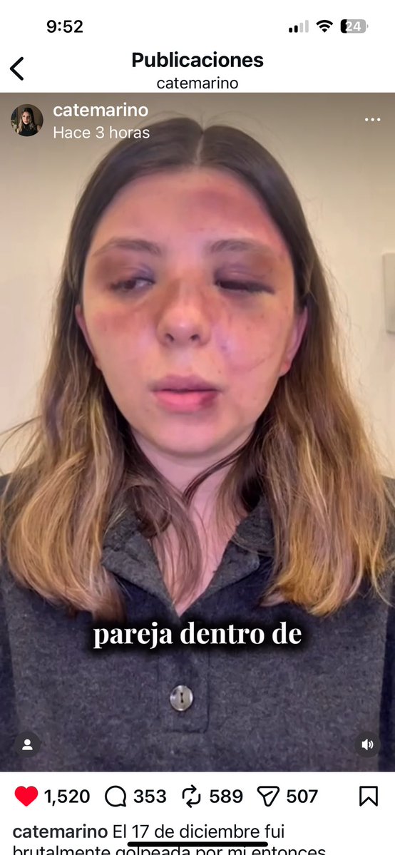 JuanPabloFdz's tweet image. Ella es Ana Caterina y ya puso una denuncia contra el cobarde de su ex-novio Gustavo “N”, que la golpeó de forma brutal, en lo que constituye un intento de feminicidio. Le tienen que dar 17 años de cárcel como al “fofo” Márquez. Actúen ya, qué esperan @FiscaliaCDMX? RT porfa.