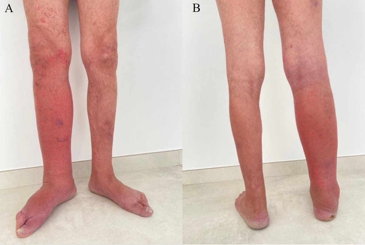 OAE_RDODJ's tweet photo. Recent article:
 Lymphedema and erysipelas in patients with classic Fabry disease — a retrospective case series describing these complications in real-world clinical practice.
🔗 https://t.co/TyPjYW70Az

#FabryDisease #RareDiseases #ClinicalResearch #CaseSeries https://t.co/1w53o9cc7t
