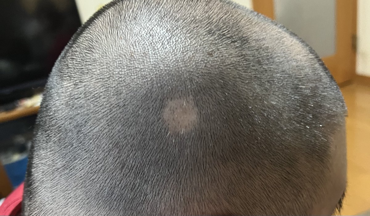 くっきり禿げてて草w
悩みなんてねえわwwwwww