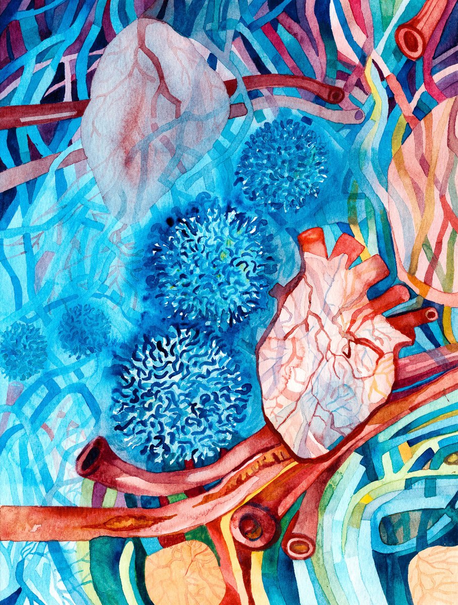 rouchelle45's tweet photo. Our beautiful commissioned artwork for the IVORY trial paper published Nature Medicine: https://t.co/GsCWECpcSS 

Depicting the regulatory T cells in blue, calming inflammation in blood vessels after heart attacks.

The trial results show that  in high-risk individuals who presented with heart attacks 🫀, low-dose interleukin 2 therapy led to a, 
⬆️ Regulatory T cells 
⬇️ Arterial inflammation 🔥 &
A trend towards a ⬇️ Major adverse cardiovascular outcomes ❤️‍🔥 at 2 years interim analysis of the IVORY-FINALE study