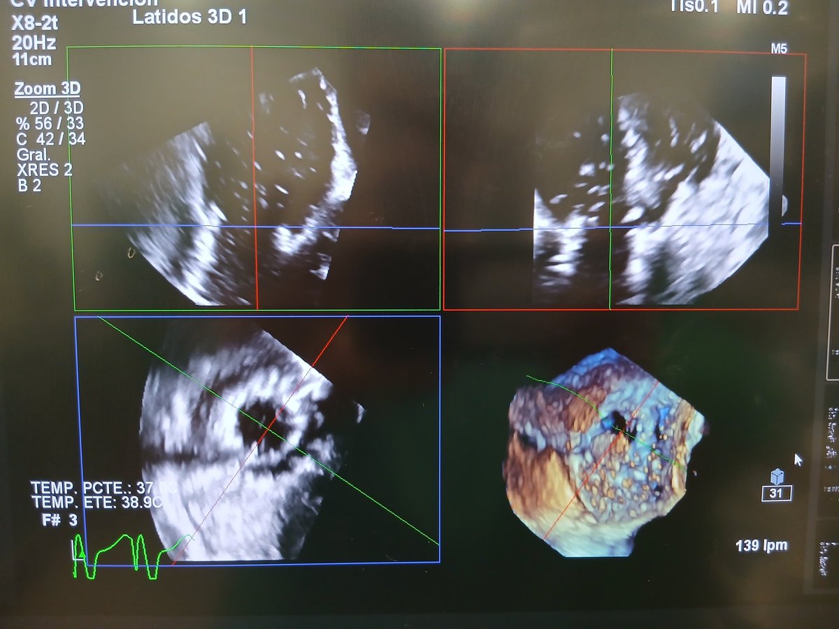 manuelbarreirop's tweet photo. First two #TTVR cases with TriCares Topaz platform in Spain. Excellent result, easy and fast deployment. Still pushing on advanced tricuspid therapies for our patients @cardiochuvi @Hosp_ACunqueiro https://t.co/dhclwIDNjs