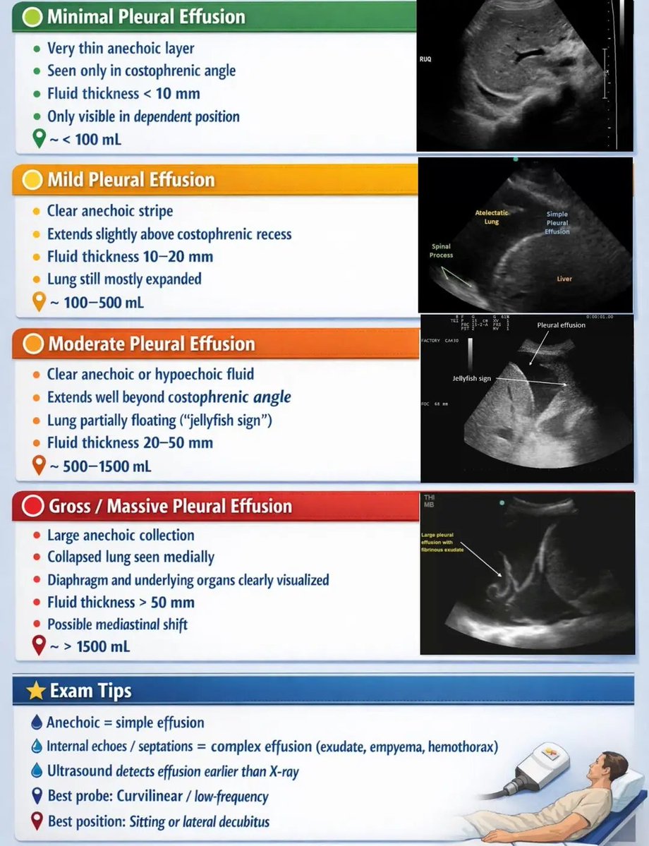 mznljrdy47597's tweet image. Ultrasound Grading of Pleural Effusion
#Ultrasound #PleuralEffusion #POCUS #ChestUltrasound #MedicalImaging #CriticalCare #radiology