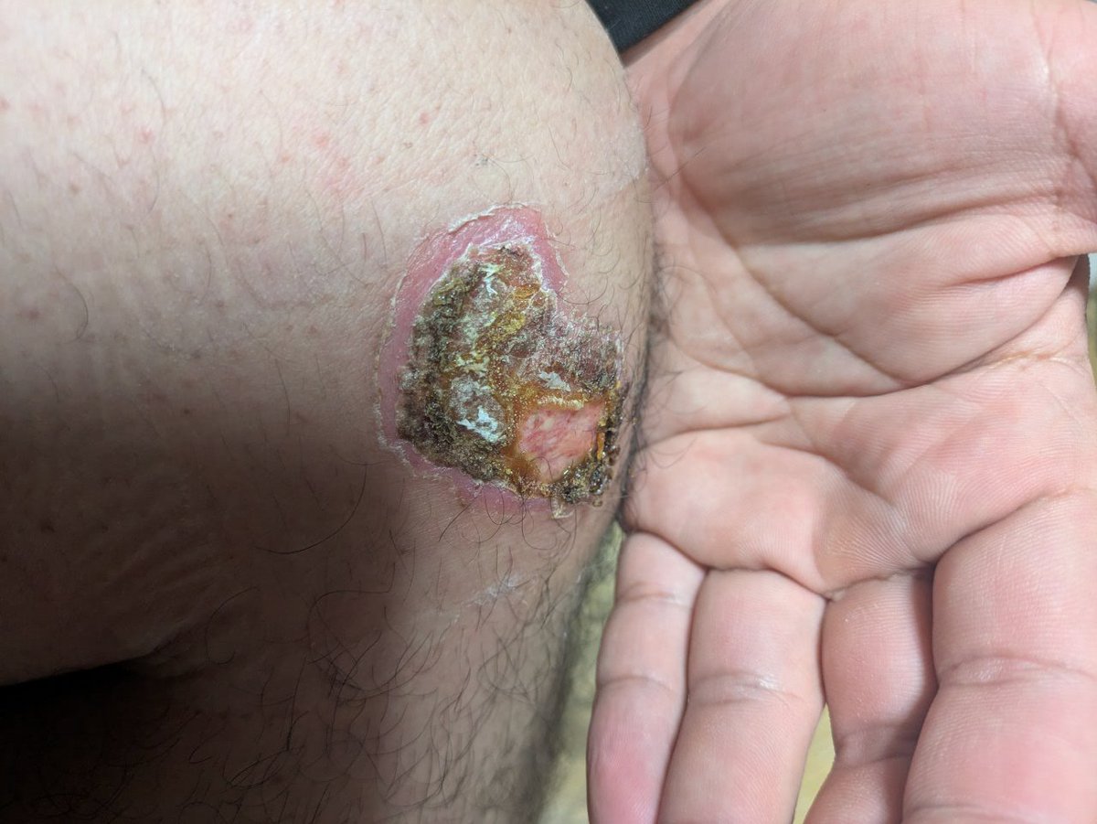 膝もう少しで治りそう