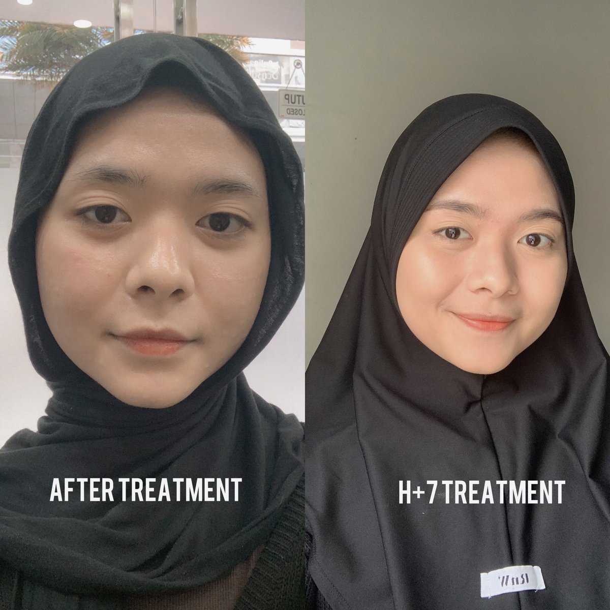 reviewbydica's tweet image. Awal tahun dimulai dengan nyobain combo treatment laser dan injeksi di dermies max😍
Takut banget ketagihan kalo hasilnya sebagus ini dan harganya juga affordable🙆🏻‍♀️