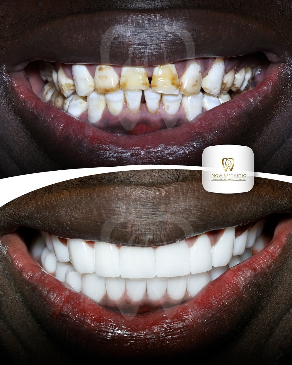 now_aesthetic's tweet photo. Now Aesthetic | Zirconium Crown 🦷📷 #dentalveeners #porcelainveneers #dentalveneers #emaxveneers #veneers_smile #smiledesign #hollywoodsmile https://t.co/fgVmogQyrA