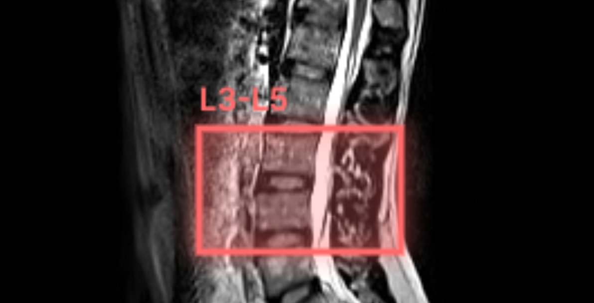 kimmonismus's tweet photo. This is insane:

Shopify CEO Tobi Lutke didn't want to have his MRI scans, which were stored on a USB stick, analyzed by commercial Windows software.

So, with Claude's help, he developed his own software in minutes - software that's better, clearer, and pinpoints the exact problem areas!

It's the end of SaaS.