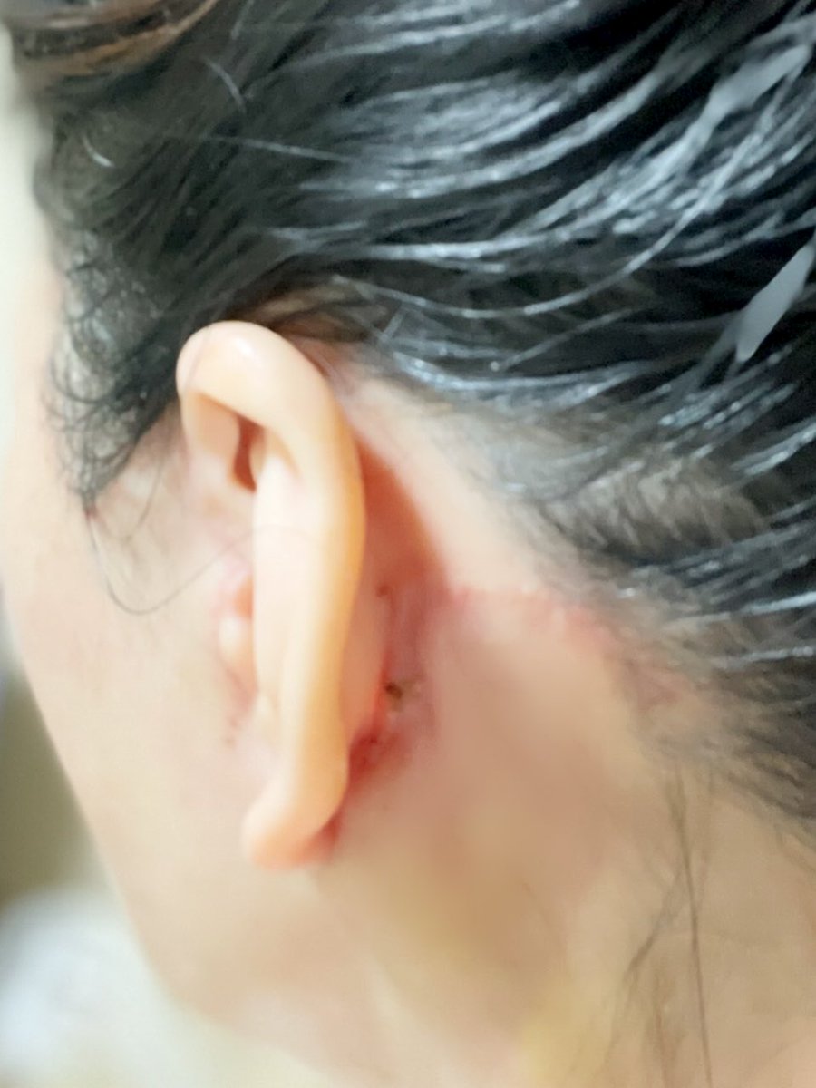 kiko 切開リフトDT中 tweet media