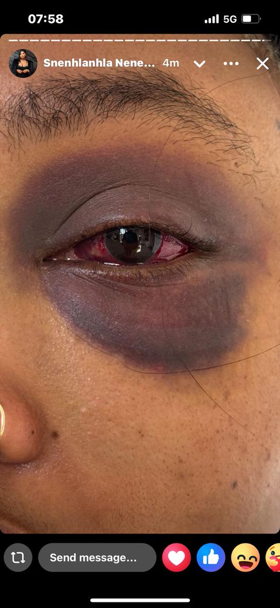 UPDATE: The 24 year-old Umlazi man who assaulted his 31 year-old girlfriend has been arrested after a public uproar, and the swift intervention of Lt General Nhlanhla Mkhwanazi - KZN Tonight Podcast