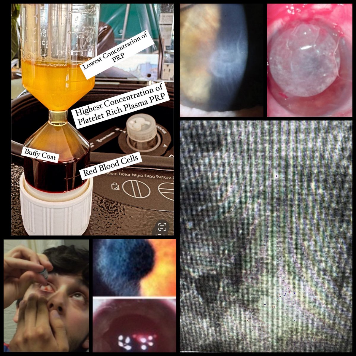Probably don’t talk about this enough but how I have used Platelet Rich Plasma PRP drops to prevent, remove, or heal the cornea. The cornea confocal microscope can help you determine depth and severity. PRP contains anti-inflammatory and immunomodulatory cytokines, growth