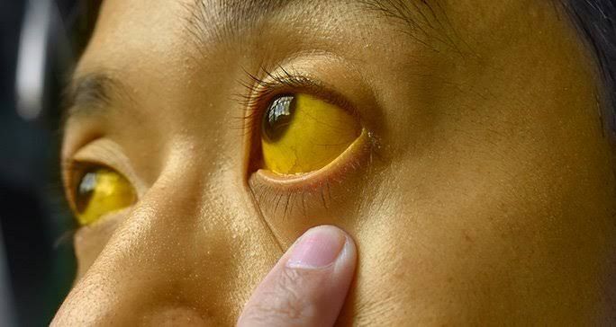 DocPriyamMD's tweet image. Today during evening ward rounds, I almost had a full verbal argument with an attendant.
The kind that stays with you long after duty ends.

A 39-year-old woman.
Eyes so yellow they didn’t look real.
A distended abdomen, tense with fluid.

She had been admitted 3 days ago.

She…