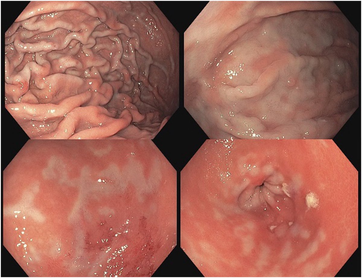 sepdigestiva's tweet photo. #QuizSEPD
📸🔍 Aspecto endoscópico peculiar del estómago en un paciente con dolor abdominal alto
¿Cuál es el diagnóstico?
rt @drkeithsiau 
#SEPD2026 https://t.co/yGdFXVtwKe