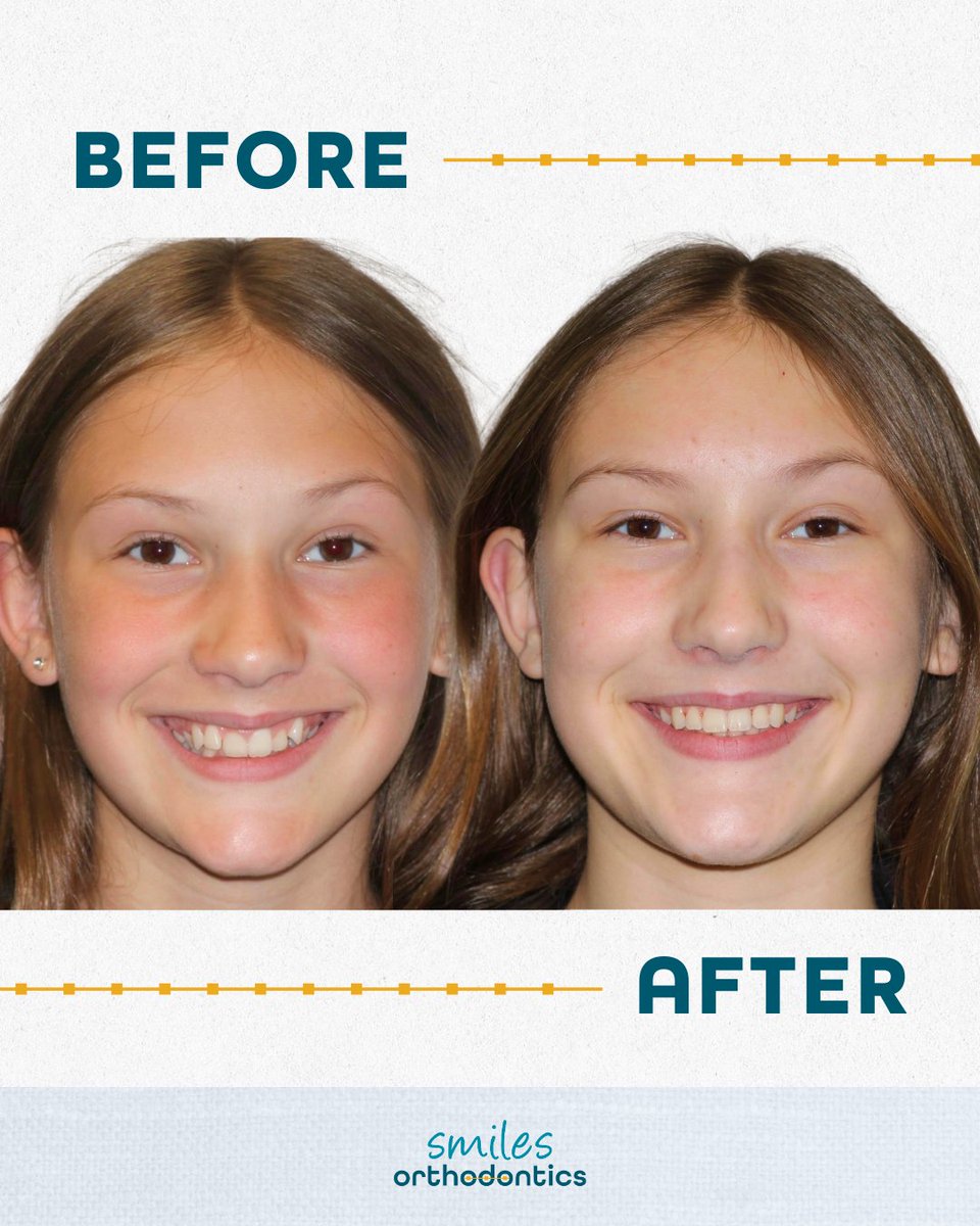 smilesortho's tweet image. Rylee is heading into the new year with a brand new smile! ✨ What a beautiful transformation and an even brighter reason to smile. 😁

#NewSmile #SmileTransformation #Orthodontics #WichitaKS #SmilesOrthodontics