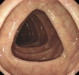 sepdigestiva's tweet photo. #QuizSEPD
🔍🧠 El colon transverso se reconoce por su forma triangular ¿Alguien puede explicar por qué ocurre esto?
rt @drkeithsiau
#SEPD2026 https://t.co/hwNQ6ENYom