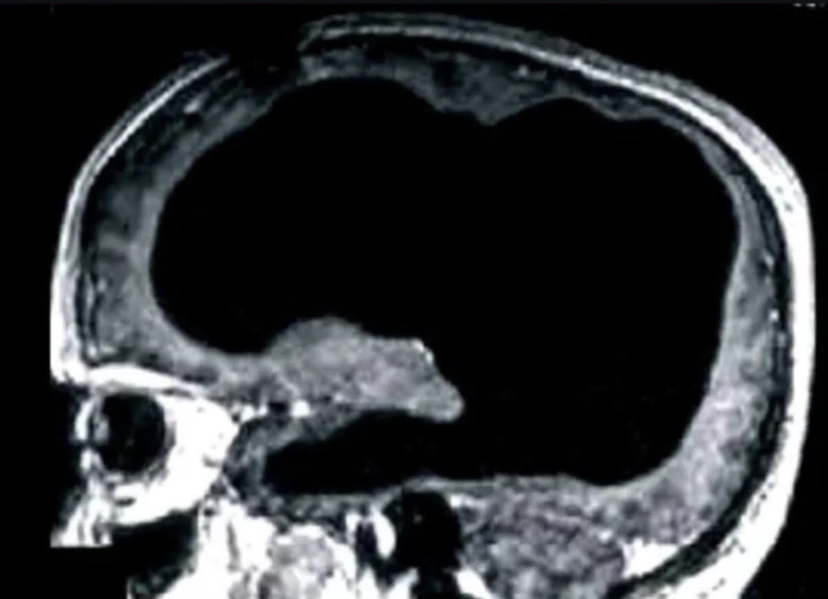 historyinmemes's tweet image. A man was discovered to be unknowingly missing 90% of his brain, yet he was living a normal life..