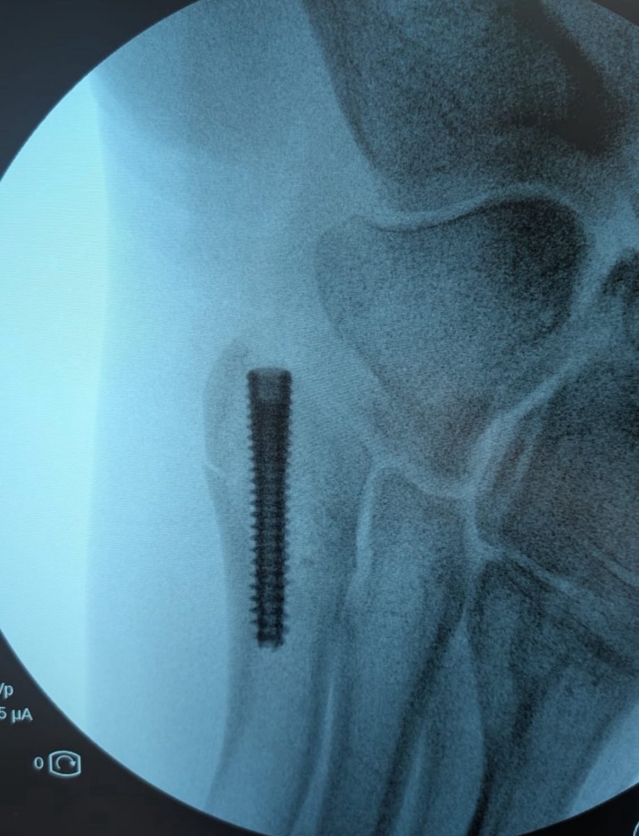 lucasaganronald's tweet image. What beautiful news we got today. Just nine days after his ankle injury (and surgery) Wout van Aert is already back riding on a bike outdoors. 🥹 Let’s go, Wout 🫶🏻

📷: posted by Wout himself