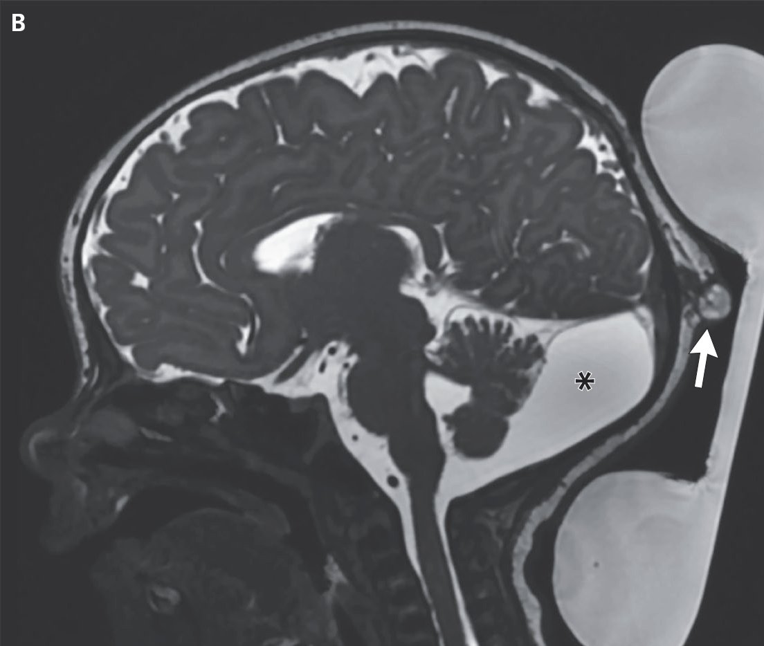 NEJM's tweet photo. Images in Clinical Medicine: Atretic Cephalocele https://t.co/7aJdt2wF5p

#Neurology #Pediatrics https://t.co/f7Mt7YMqps