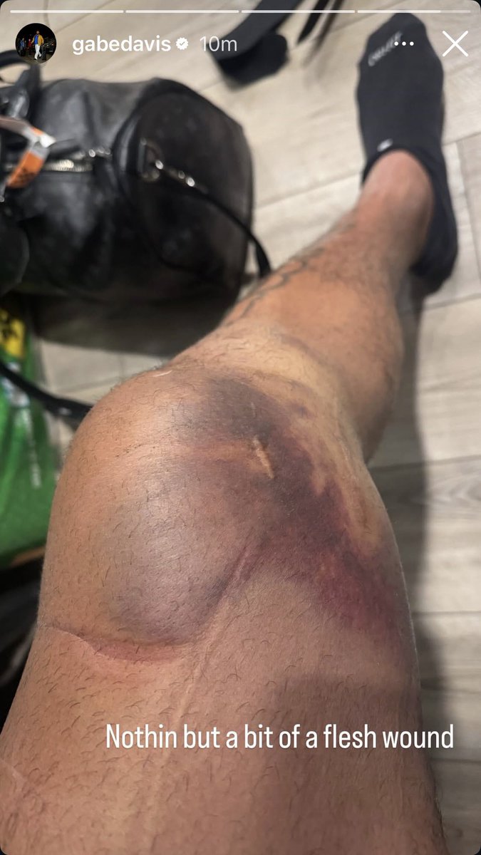 BillsLead's tweet photo. Gabe Davis posted his knee on instagram:

😳 https://t.co/mDJ3r56AuA