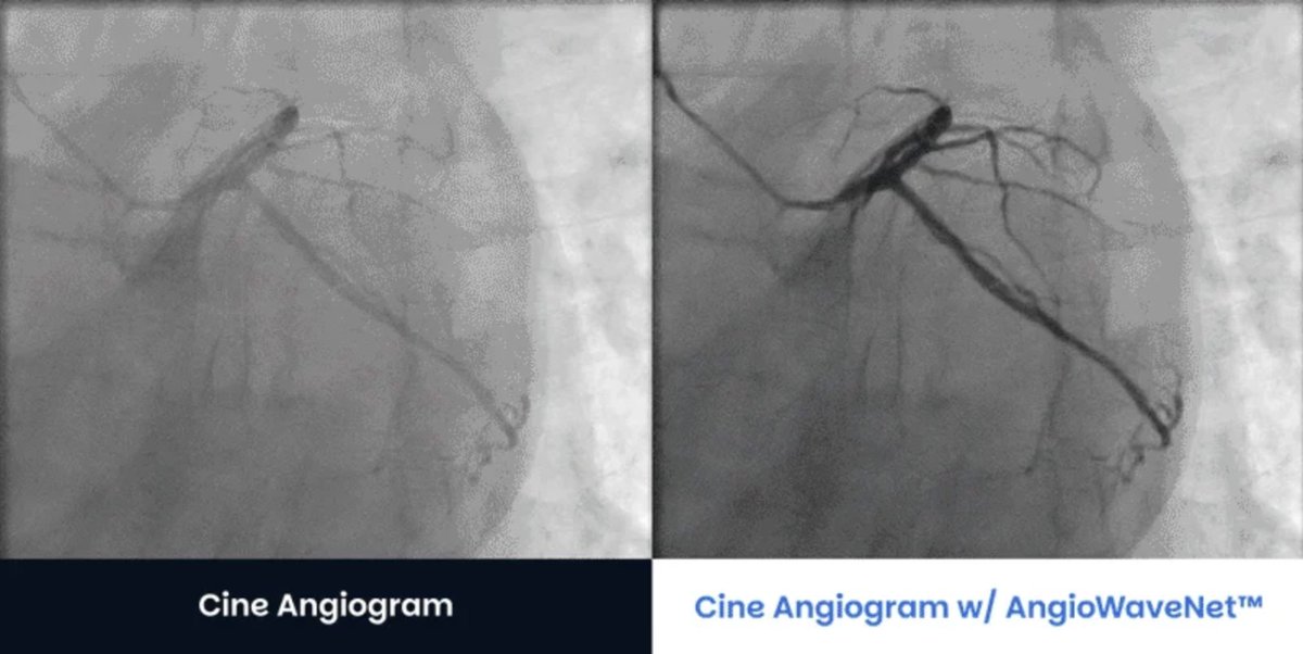 Angiowave's tweet image. Sharper angiograms can change how you approach a case. AngioWave enhances standard Angio’s to reveal clearer vessel detail—especially when image quality is limited.

#Cardiology #AIImaging