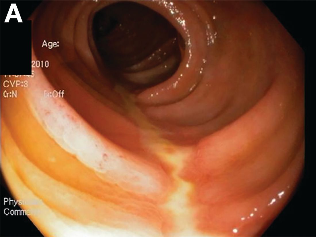 sepdigestiva's tweet photo. 🔍🩸 La colitis isquémica suele afectar a las zonas “watershed” del colon. En la endoscopia, el “single stripe sign” es patognomónico y corresponde al borde antimesentérico, donde el aporte sanguíneo es menor.
#4kmeded #gitwitter https://t.co/AEU0EoSBQy