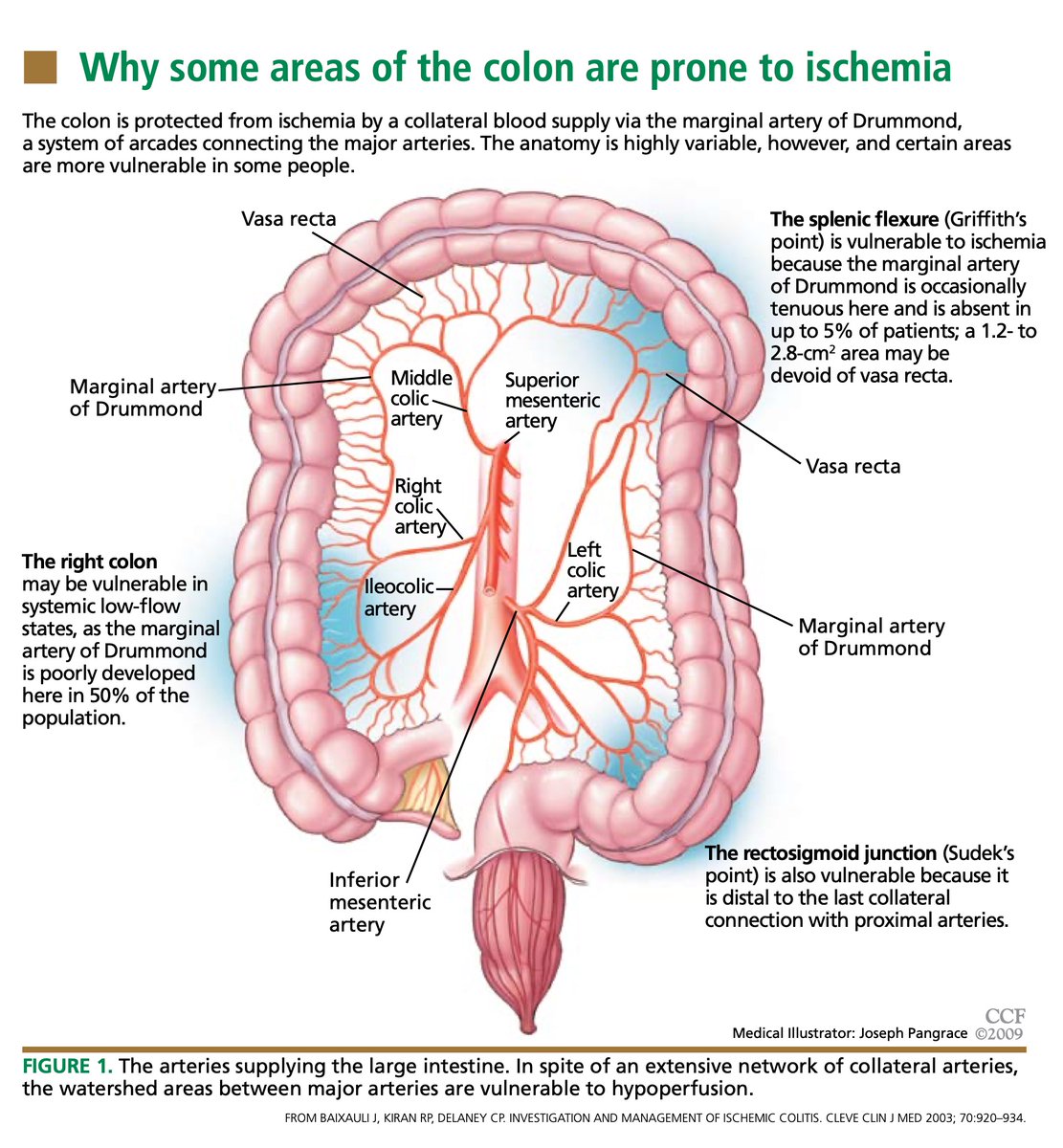 sepdigestiva's tweet photo. 🔍🩸 La colitis isquémica suele afectar a las zonas “watershed” del colon. En la endoscopia, el “single stripe sign” es patognomónico y corresponde al borde antimesentérico, donde el aporte sanguíneo es menor.
#4kmeded #gitwitter https://t.co/AEU0EoSBQy