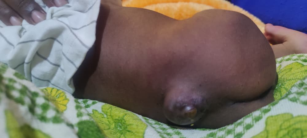 RuharoHospital's tweet photo. Spina bifida is a congenital neural tube defect, but over 70% of its risk can be reduced by taking folic acid before conception and in early pregnancy. A small tablet can make a big difference. #FolicAcid #BirthDefectsPrevention #SpinaBifida #CBR
@cbmWorldwide @ifsbh @TBekson https://t.co/H8h2hgp5sU