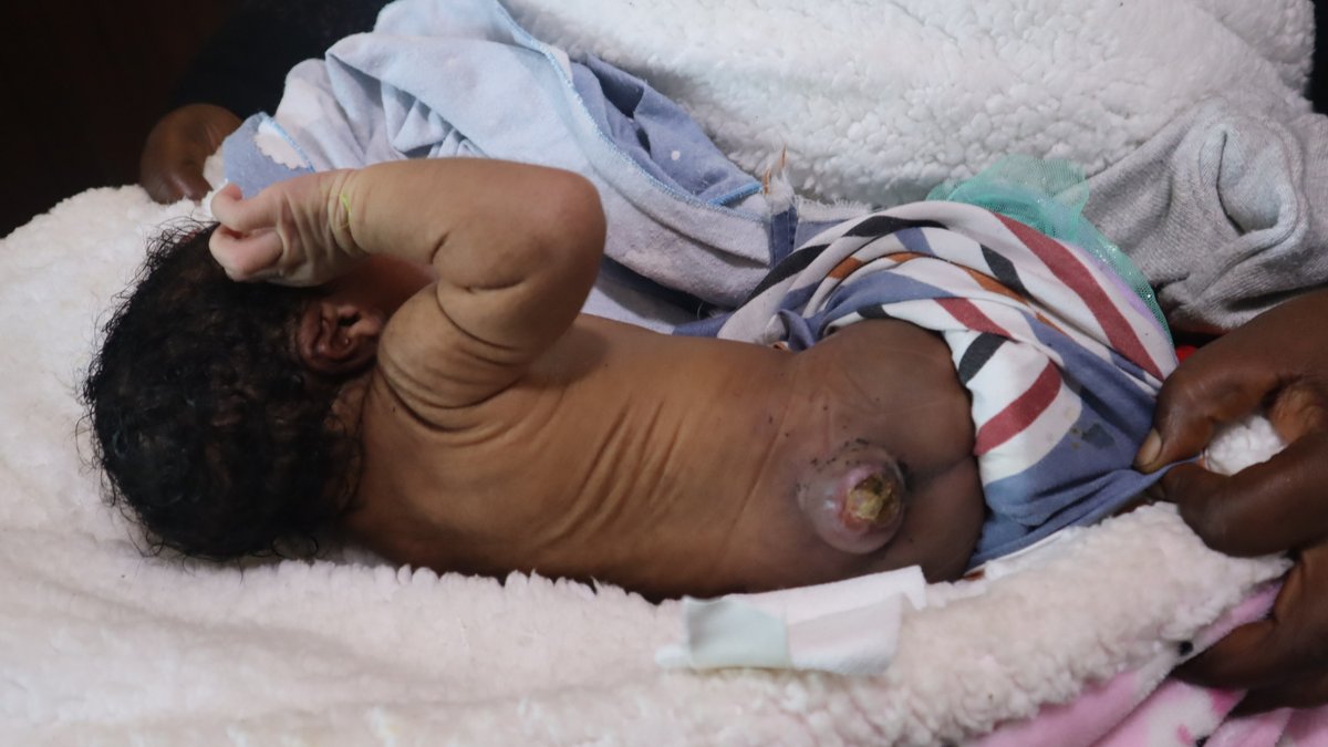 RuharoHospital's tweet photo. Spina bifida is a congenital neural tube defect, but over 70% of its risk can be reduced by taking folic acid before conception and in early pregnancy. A small tablet can make a big difference. #FolicAcid #BirthDefectsPrevention #SpinaBifida #CBR
@cbmWorldwide @ifsbh @TBekson https://t.co/H8h2hgp5sU