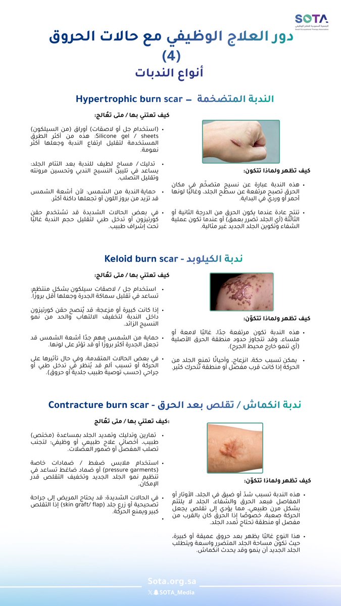ضمن سلسلة دور العلاج الوظيفي في تأهيل حالات الحروق، نسلّط الضوء على أنواع الندبات بعد الحروق، وطرق التعامل معها للحد من تأثيرها على الحركة والوظيفة.

#تأهيل_الحروق
#سفراء_سوتا