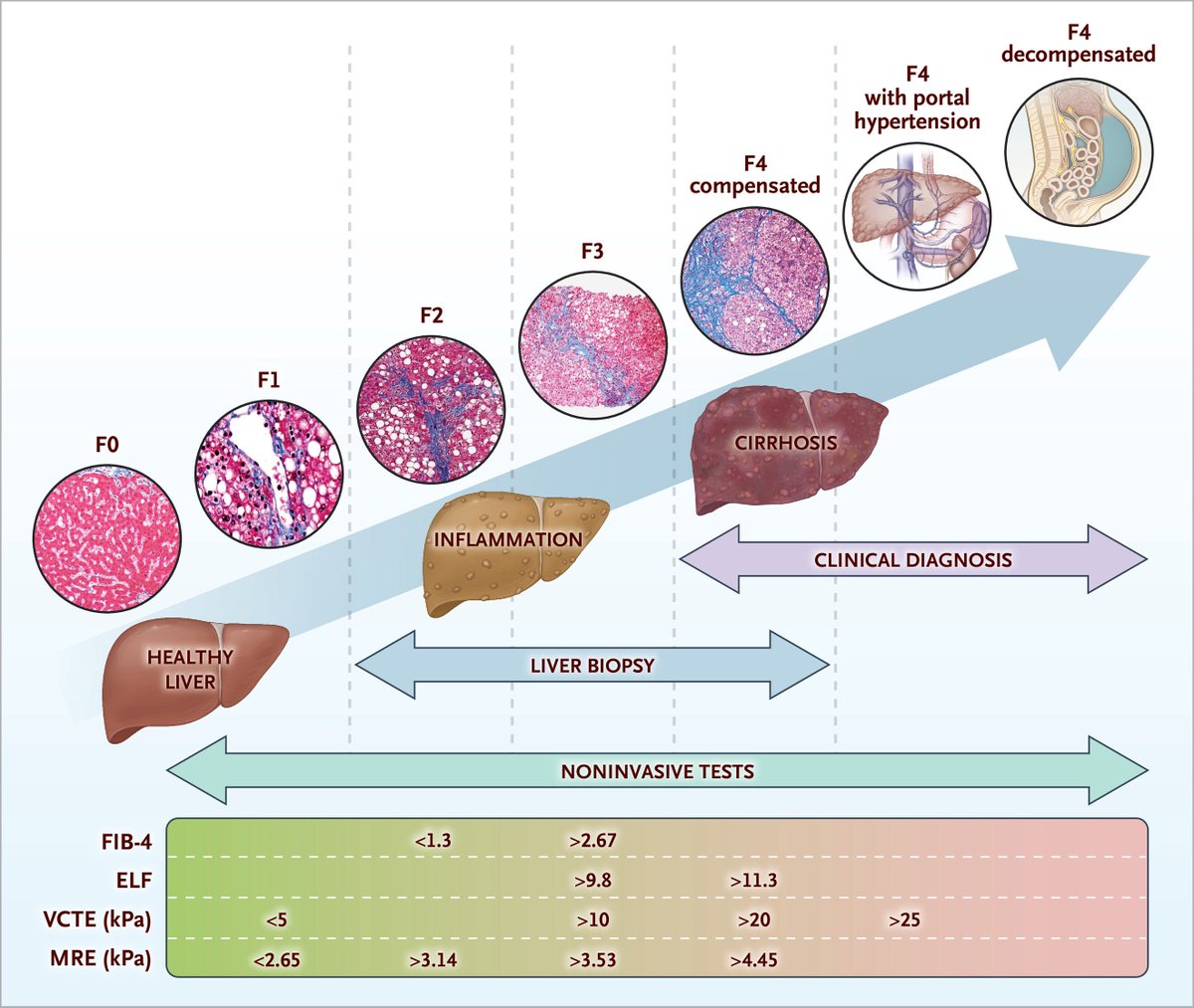 sepdigestiva's tweet photo. 💡🆕 Evaluación no invasiva de la fibrosis hepática
Nueva revisión en @NEJM 
Incluye:
1️⃣ Algoritmo de abordaje
2️⃣ Diagnóstico y estadificación de la fibrosis hepática
3️⃣ Resumen de las pruebas no invasivas

📸: https://t.co/U9UZglZEj6 https://t.co/vzbQI1I3yq