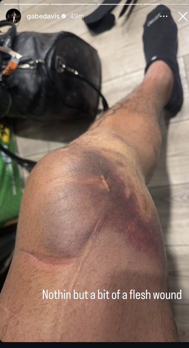 BangedUpBills's tweet image. @gabedavis13_ posted on his IG page a picture of his left knee today.

This is about what I expect the knee to look like with bruising potentially worsening. Hoping his phrasing indicates good news.

He’s going to battle to get back on the field if the opportunity is there.
