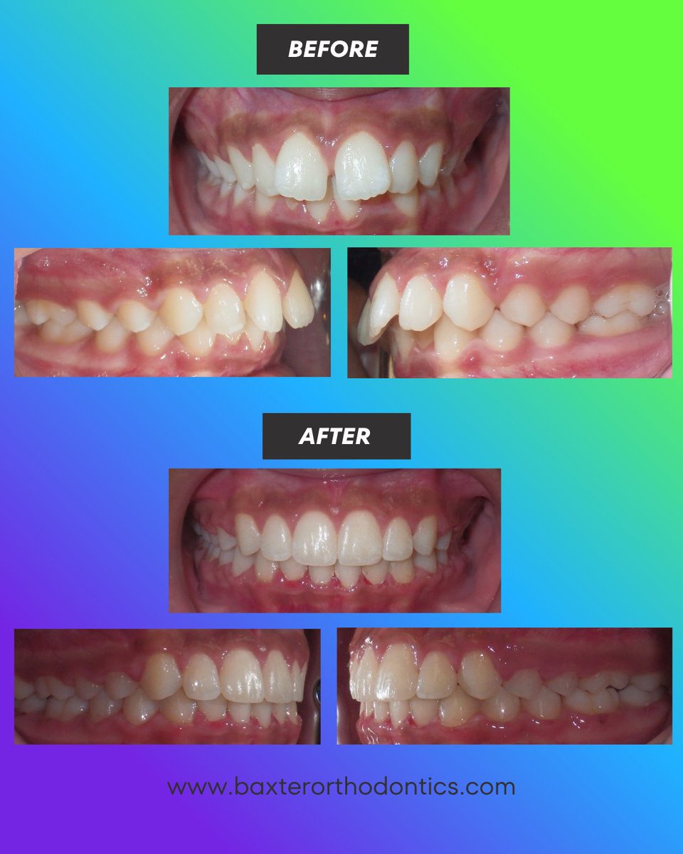 BaxterBraces's tweet photo. Makeover Monday!🤩 https://t.co/CjpSHon46O