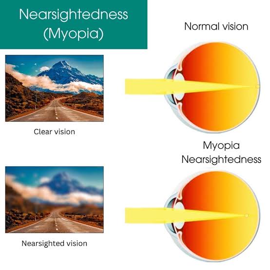 Optomedicare's tweet image. What if how you see isn't exactly how others see? 

In a world characterised by myopia epidemic, lack of awareness may lead to conclusion that how you see is normal!

To answer this question #eyecheckup is the solution. 

@PinonKhaemba

#Eyecare