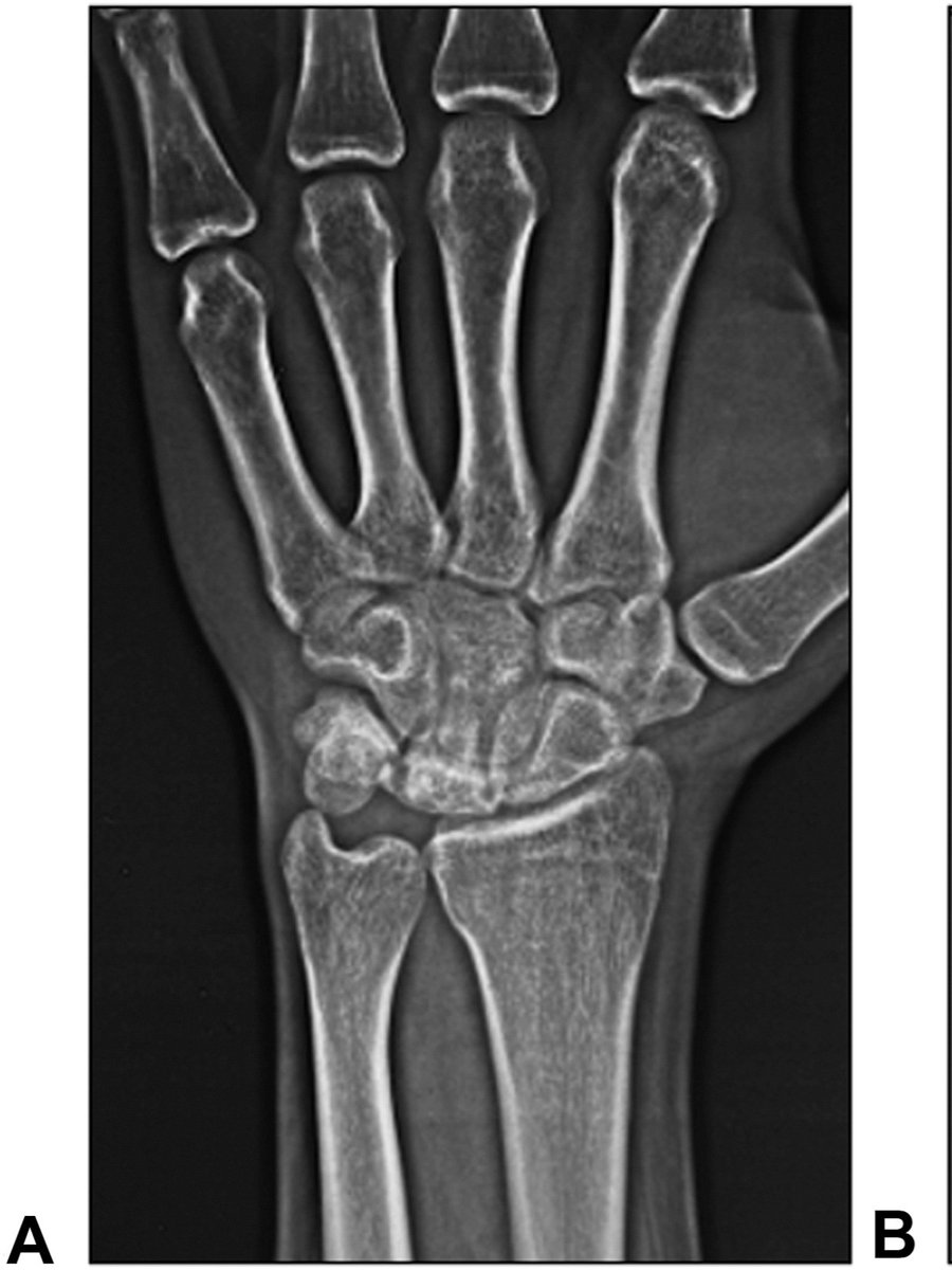JHandSurg's tweet photo. How do Kienbock patients do after a radial shortening osteotomy long-term? This new study shows stable results at the 20-year mark. Read more in this new JHS article!
https://t.co/oxUBfIgD4c
#JHS #handsurgery #Kienbock #Evidencebasedmedicine https://t.co/yEAztmdn6p