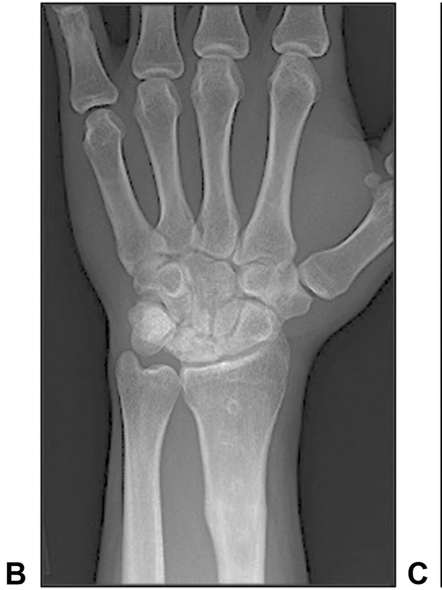 JHandSurg's tweet photo. How do Kienbock patients do after a radial shortening osteotomy long-term? This new study shows stable results at the 20-year mark. Read more in this new JHS article!
https://t.co/oxUBfIgD4c
#JHS #handsurgery #Kienbock #Evidencebasedmedicine https://t.co/yEAztmdn6p