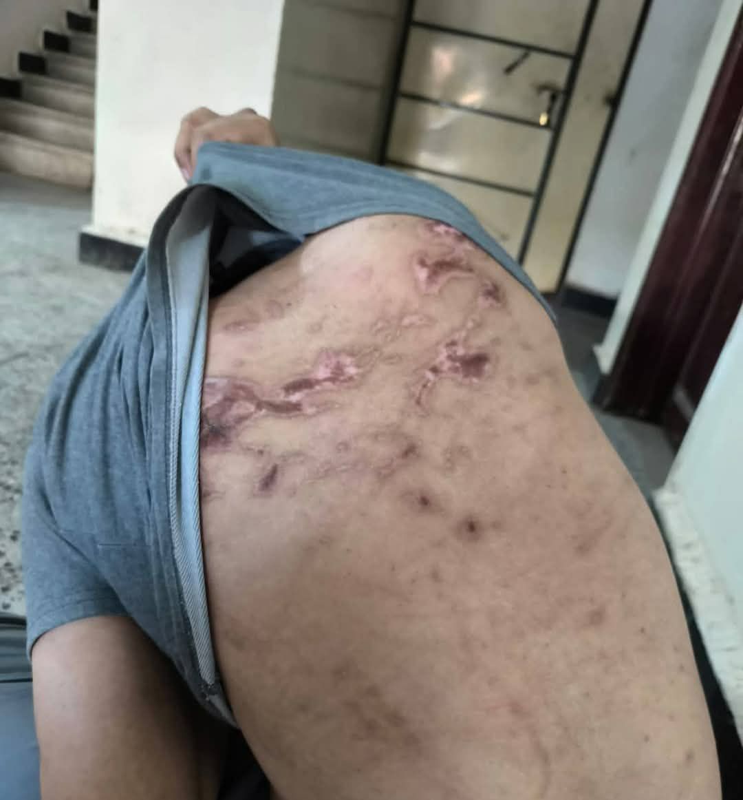 صور صادمة من سجون الإمارات في المكلا تظهر آثار التعذيب الوحشي على معتقل أبرياء من حضرموت، ضحايا الانتهاكات الإماراتية التي طالت المدنيين بلا رحمة، خارج أي قانون أو أي رادع إنساني.