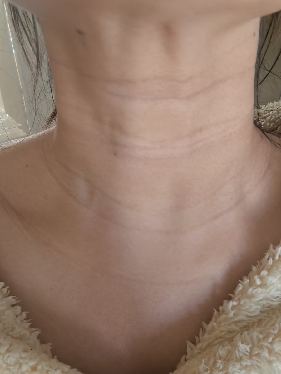 soi_beauty's tweet image. 20代30代でこっち系の首のシワできてる人はまじで早めにケアした方がいいよ🤮