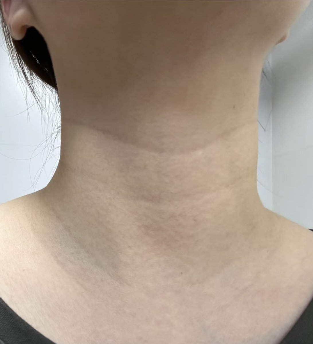 soi_beauty's tweet image. 20代30代でこっち系の首のシワできてる人はまじで早めにケアした方がいいよ🤮