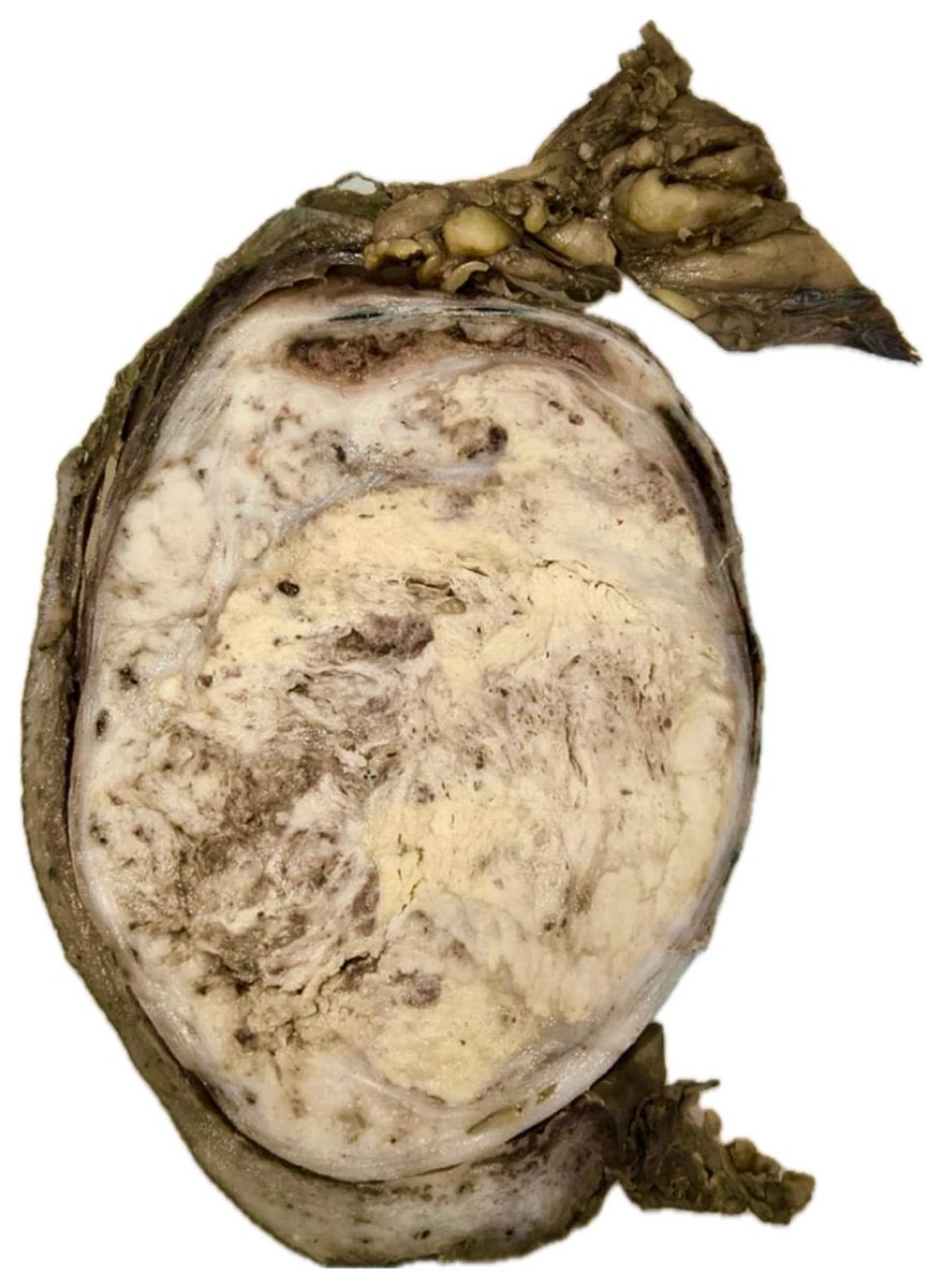 vintage81106614's tweet image. The art of grossing. A 29 yo man with right testicular pain. Radical Orchiectomy + Partial Scrotectomy. 7.6x5.4cm tumor. Final Diagnosis. Viable Tumor: Yolk Sac Tumor (20%)+ Embryonal Carcinoma (10%) + Extensive Necrosis (70%). #pathology #pathresidents #GUpath ⁦@pathTweeter