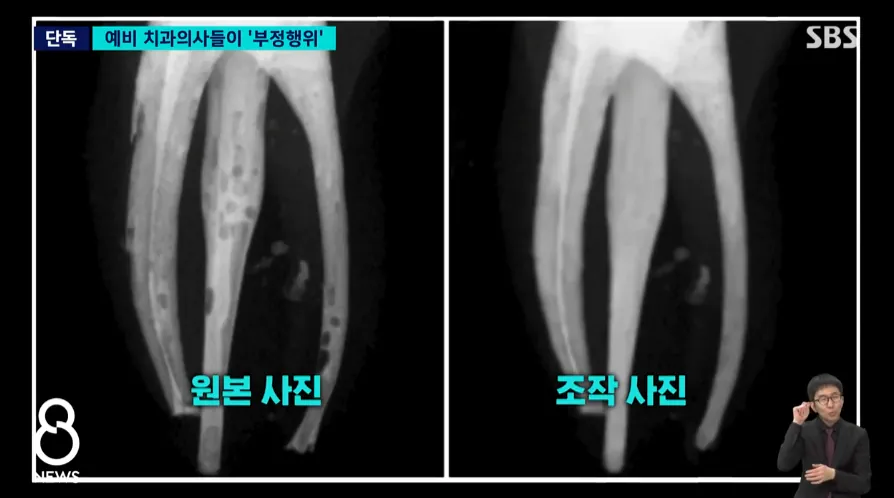 연세대 예비 치과의사들이 단체로 신경치료 실습 사진을 조작하다 적발됨
한두명도 아니고 수업 들은 59명 중 과반인 34명이 포토샵으로 과제를 조작하고 베껴서 제출했는데
이런 치대생들이 곧 치과의사가 될 예정