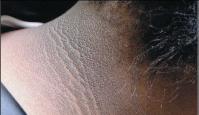 UzmEsraGunes's tweet image. Boyunda, ensede yada koltuk altında kararma, deride oluşan et beni gibi deriler (akantozis nigrikans, keratozis pilaris ve plantar hiperkeratoz) genellikle İNSÜLİN DİRENCİNİN ilk belirtilerileri olabiliyor. İnsülin direnci de diyabet ve diğer metabolik bozuklukların öncüsüdür.…