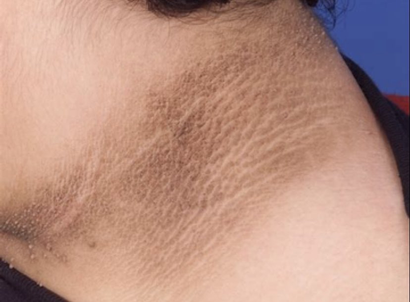 UzmEsraGunes's tweet image. Boyunda, ensede yada koltuk altında kararma, deride oluşan et beni gibi deriler (akantozis nigrikans, keratozis pilaris ve plantar hiperkeratoz) genellikle İNSÜLİN DİRENCİNİN ilk belirtilerileri olabiliyor. İnsülin direnci de diyabet ve diğer metabolik bozuklukların öncüsüdür.…