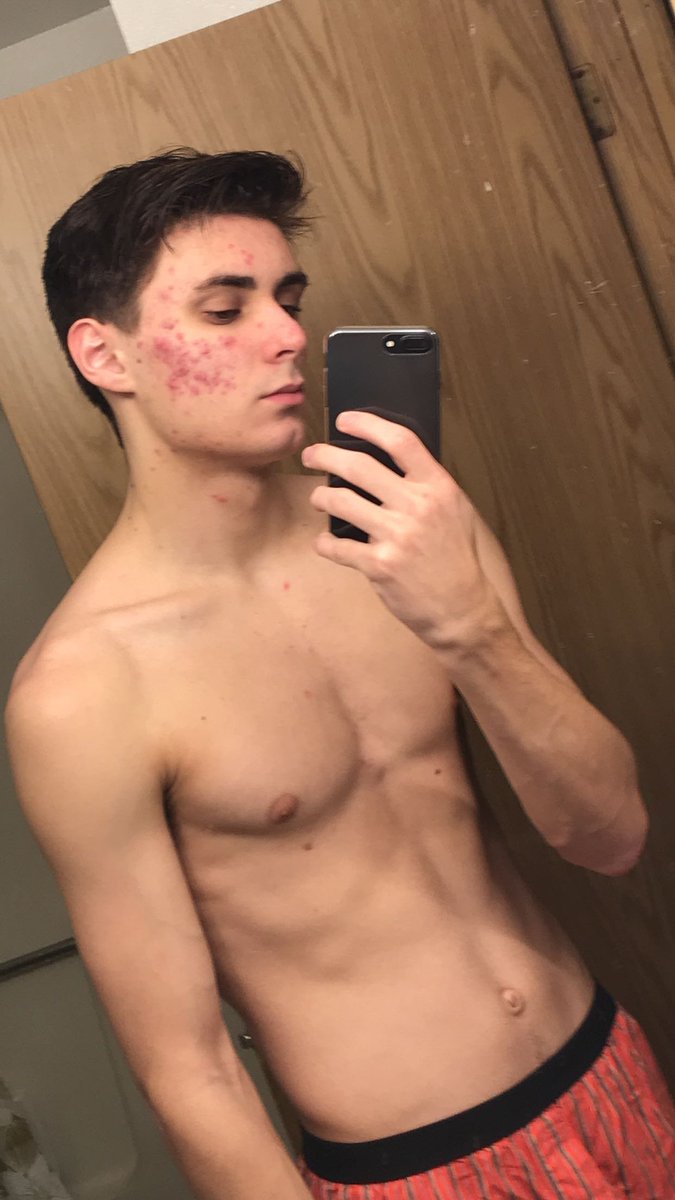 This is me at 18. If your skin is this bad you should be given free treatment. I could've looked so good when I was younger but nope 🥲 
I hope no one ever has to go through the super acne I went through.