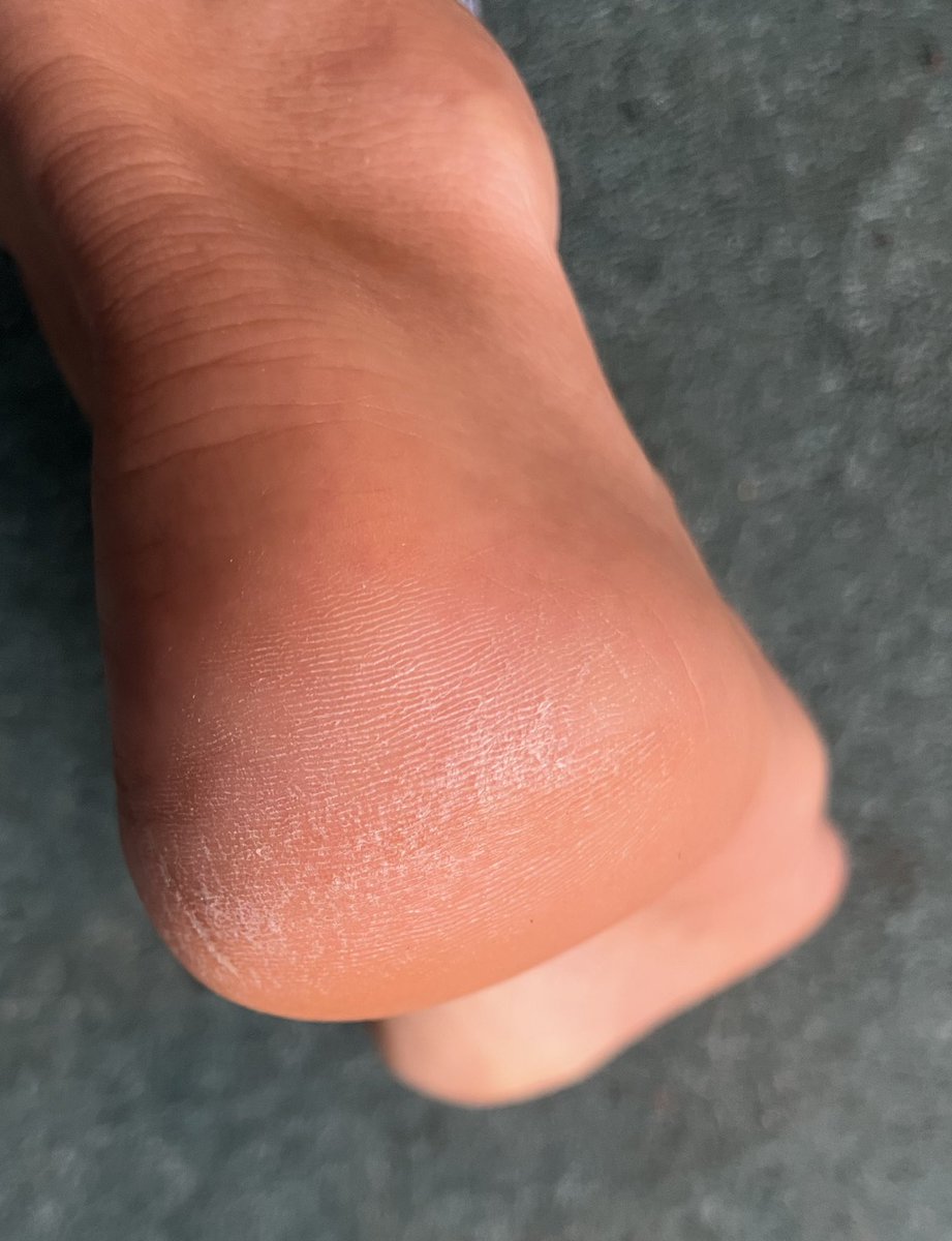 Belarus_Nikita's tweet photo. #heels #dryheels #roughsoles #feet 

Sexy or disgusting? https://t.co/OKR4QHETeO