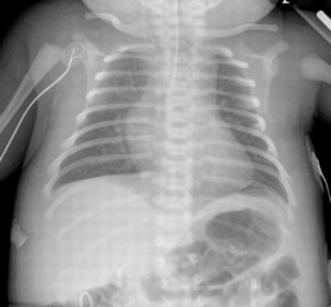 Answer is C More about Egg-on-a-String Sign: 🔲 The cardiovascular ...