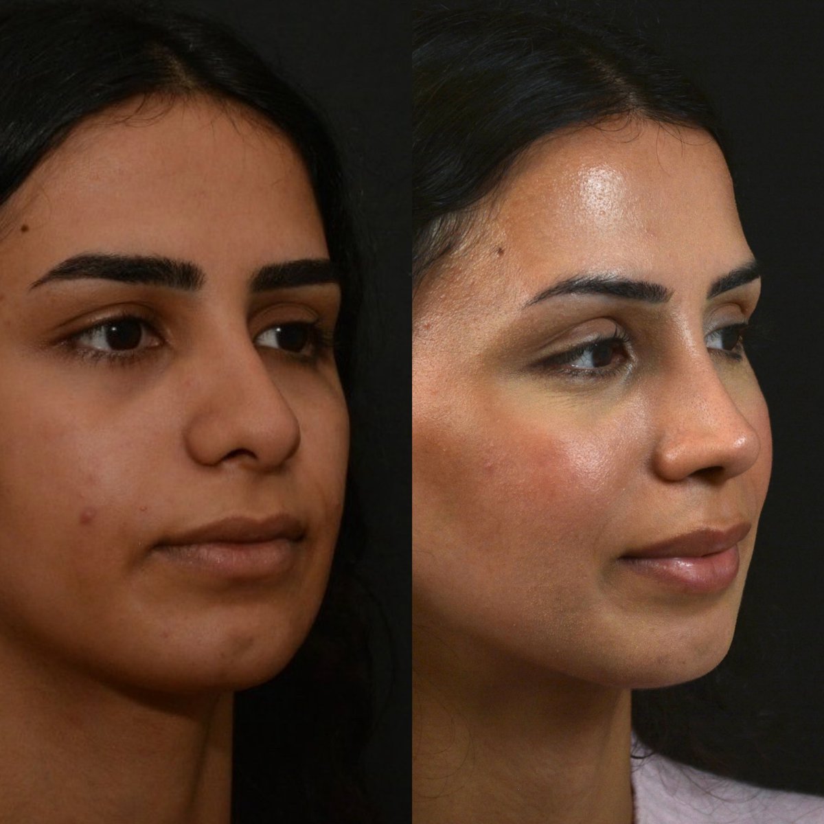 alevcamcioglu's tweet photo. A very thick skinned nose, Lovely Yağmur 5 YEARS after #nocutrhinoplasty … Rhinoplasty is NOT the operation table result surgery, but the future outcome…Long term permanent results should be the one thing you are looking for…

Contact us to get information about rhinoplasty.
Webpage: https://t.co/x91oeZ4ECk
Prices and Packages: https://t.co/BWZE5UWvn6
Before & After Photos: https://t.co/ubAkZGWZZ9

+(90)532 477 64 96 🇹🇷
+(90)535 206 10 95 🇬🇧🇩🇪

Our clinic is a recognized International Health Tourism Center by the Turkish Ministry of Health. Under the terms of this authorization and with the patient’s consent, the patient’s picture is used.
All our posts are for informational purposes .

#rhinoplasty #rhinoplastyresults #rhinoplastyturkey #rhinoplastyspecialist #rhinoplastybeforeandafter #rhinoplastyistanbul