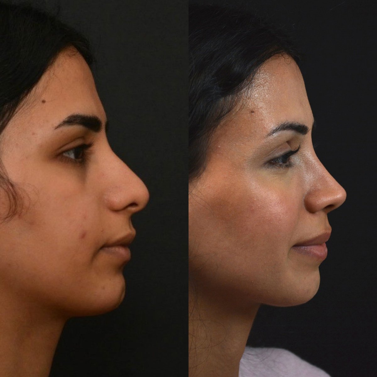 alevcamcioglu's tweet photo. A very thick skinned nose, Lovely Yağmur 5 YEARS after #nocutrhinoplasty … Rhinoplasty is NOT the operation table result surgery, but the future outcome…Long term permanent results should be the one thing you are looking for…

Contact us to get information about rhinoplasty.
Webpage: https://t.co/x91oeZ4ECk
Prices and Packages: https://t.co/BWZE5UWvn6
Before & After Photos: https://t.co/ubAkZGWZZ9

+(90)532 477 64 96 🇹🇷
+(90)535 206 10 95 🇬🇧🇩🇪

Our clinic is a recognized International Health Tourism Center by the Turkish Ministry of Health. Under the terms of this authorization and with the patient’s consent, the patient’s picture is used.
All our posts are for informational purposes .

#rhinoplasty #rhinoplastyresults #rhinoplastyturkey #rhinoplastyspecialist #rhinoplastybeforeandafter #rhinoplastyistanbul